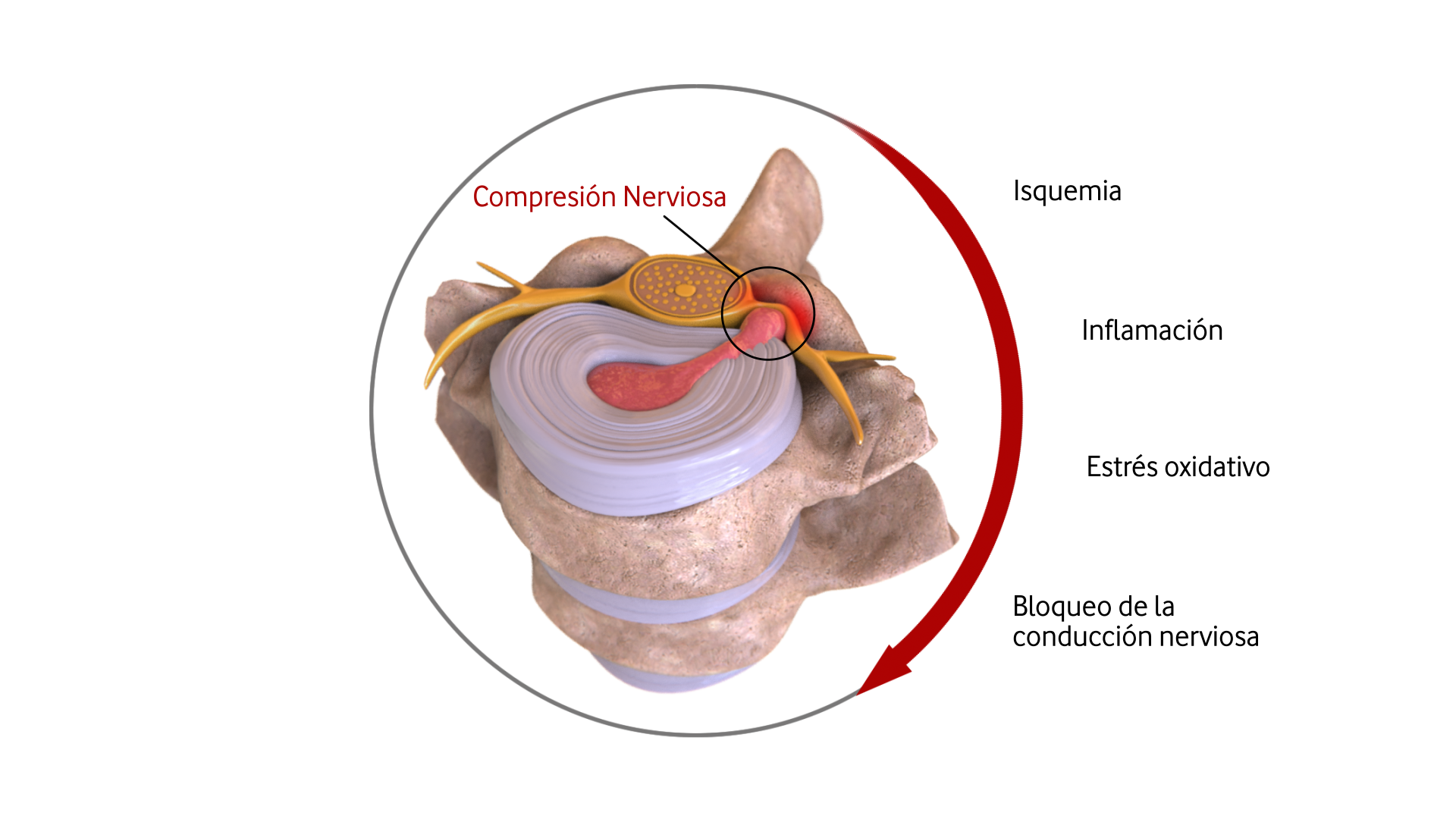 Compresión raíz nerviosa (2)